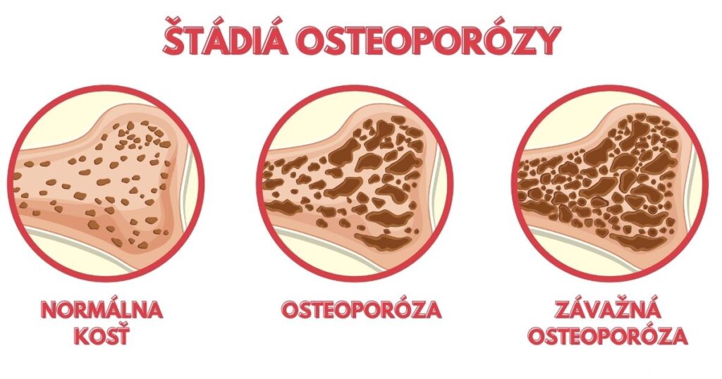 Štádiá osteoporózy