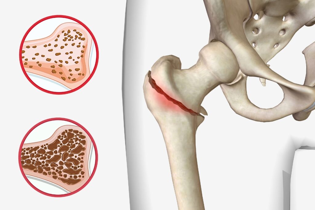 Kolagéne na kosti ako prevencia osteoporózy